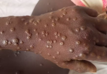 Maymun çiçeği salgını hakkında bilmeniz gerekenler